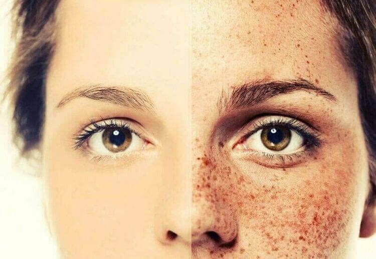 Freckle Removal